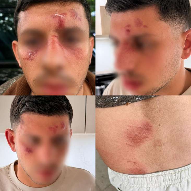 Shalev Ben Yakar's wounds after being assaulted by a group of men in Golders Green,  May 18, 2026